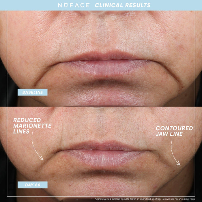 Close-up comparison of lower face showing reduced marionette lines and contoured jawline after 60 days of using MINI+ Starter Kit | NuFACE, highlighting skincare and wellness device benefits.