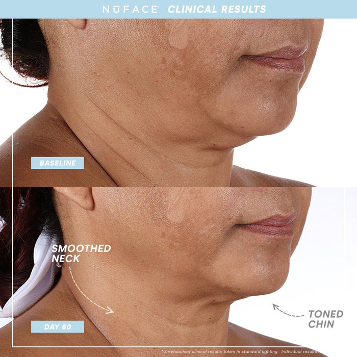 Before and after images showing improved skin texture and firmness on a woman's neck and chin after 60 days using the MINI+ Starter Kit | NuFACE skincare device.
